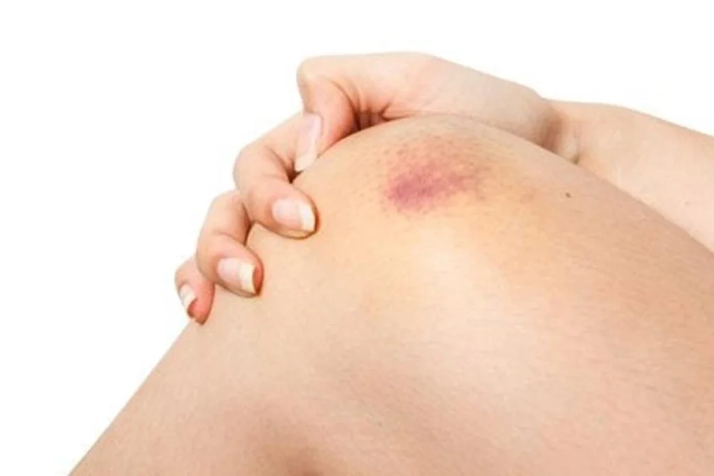 bruises-as-signs-of-spiritual-attack