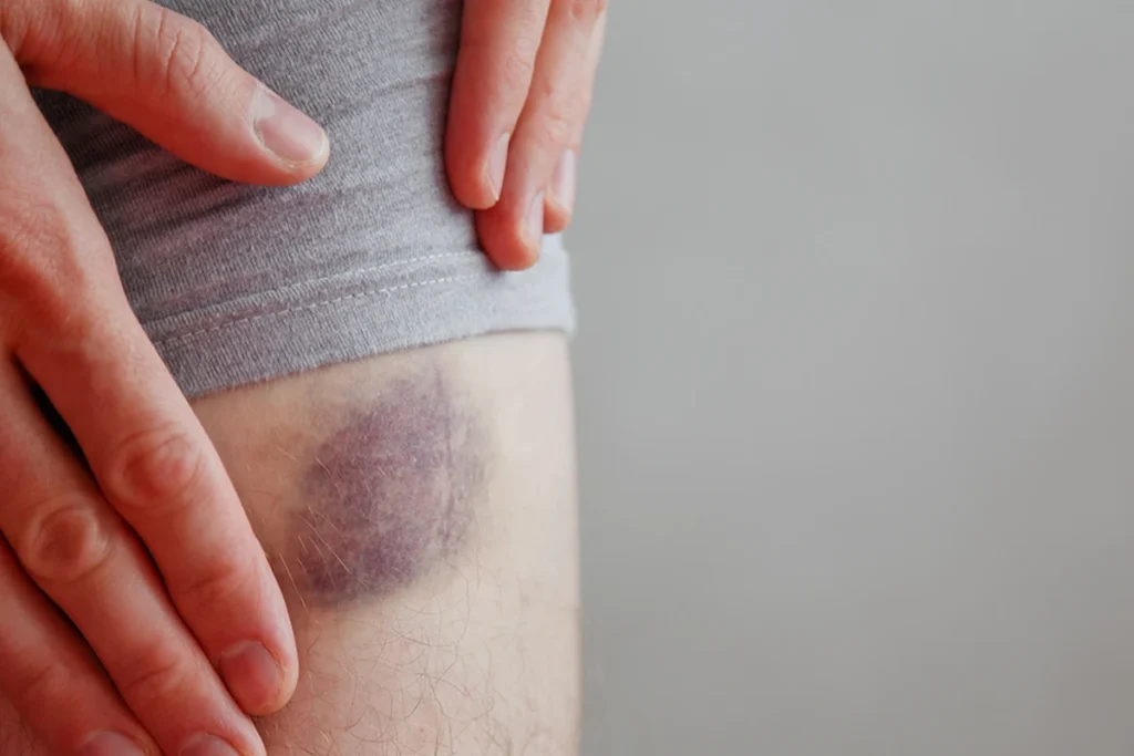 what-does-it-mean-when-bruises-randomly-appear