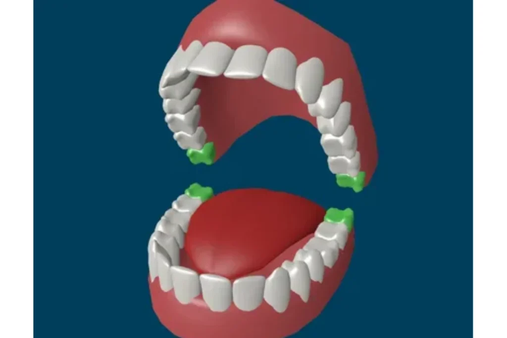 wisdom-teeth-removal